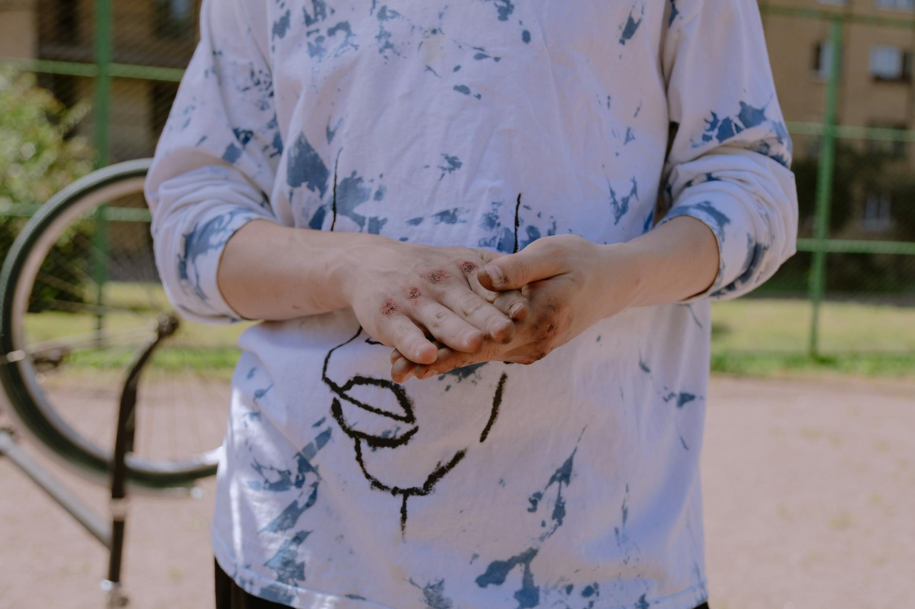A person with injured hands in a casual pose, standing outdoors near a bicycle wheel.